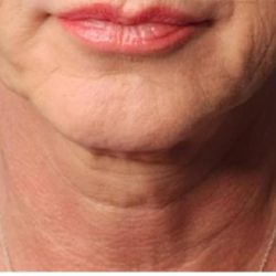 Sofwave Before & After Patient #1604